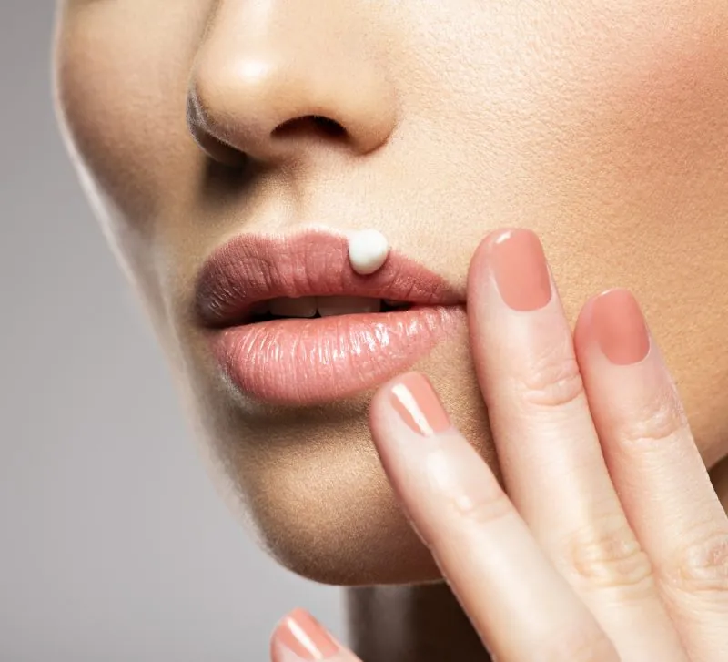 Herpes Labial: Remedios Naturales