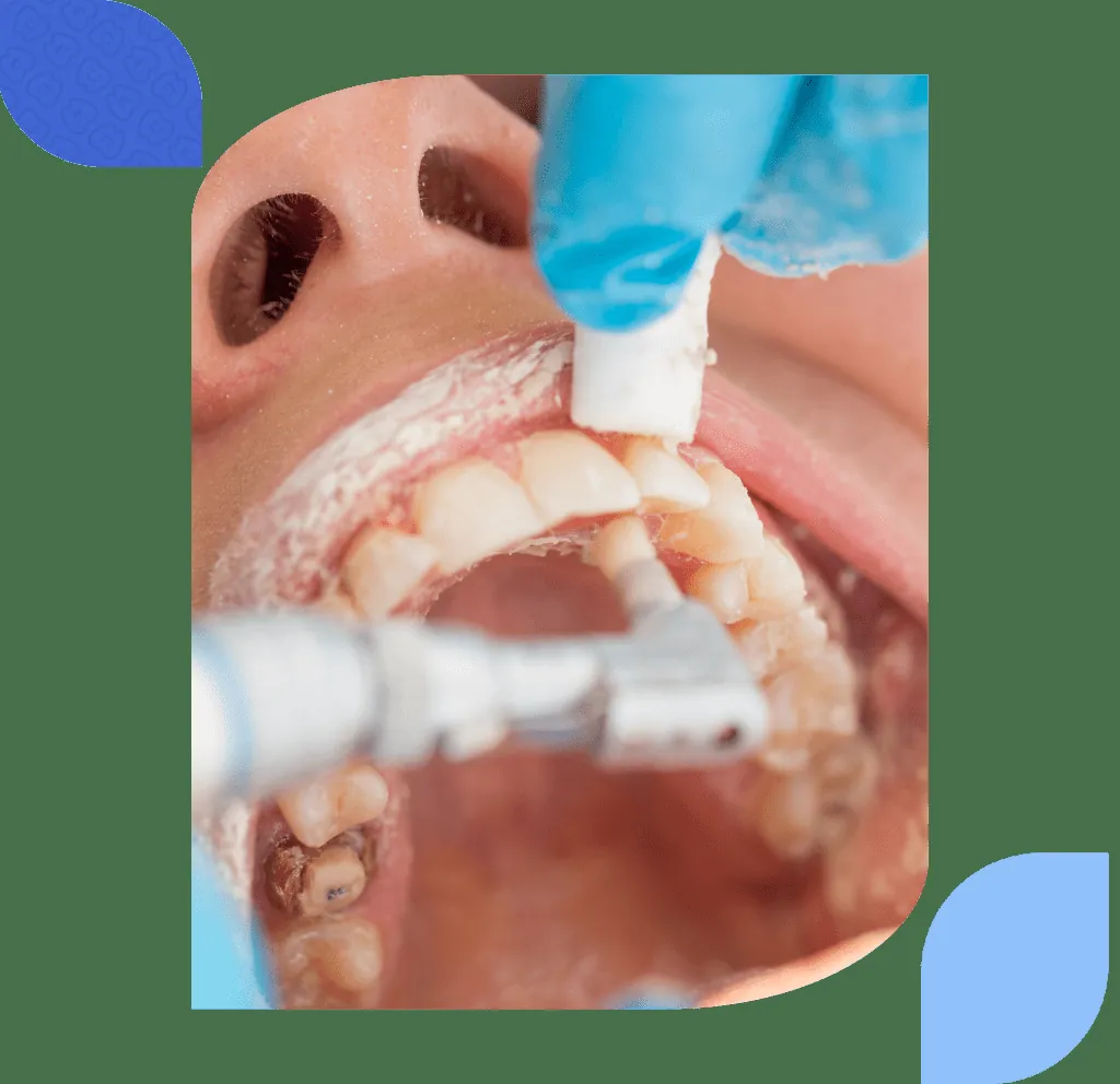 Image accompanying the article: Dental cleaning in Las Arenas