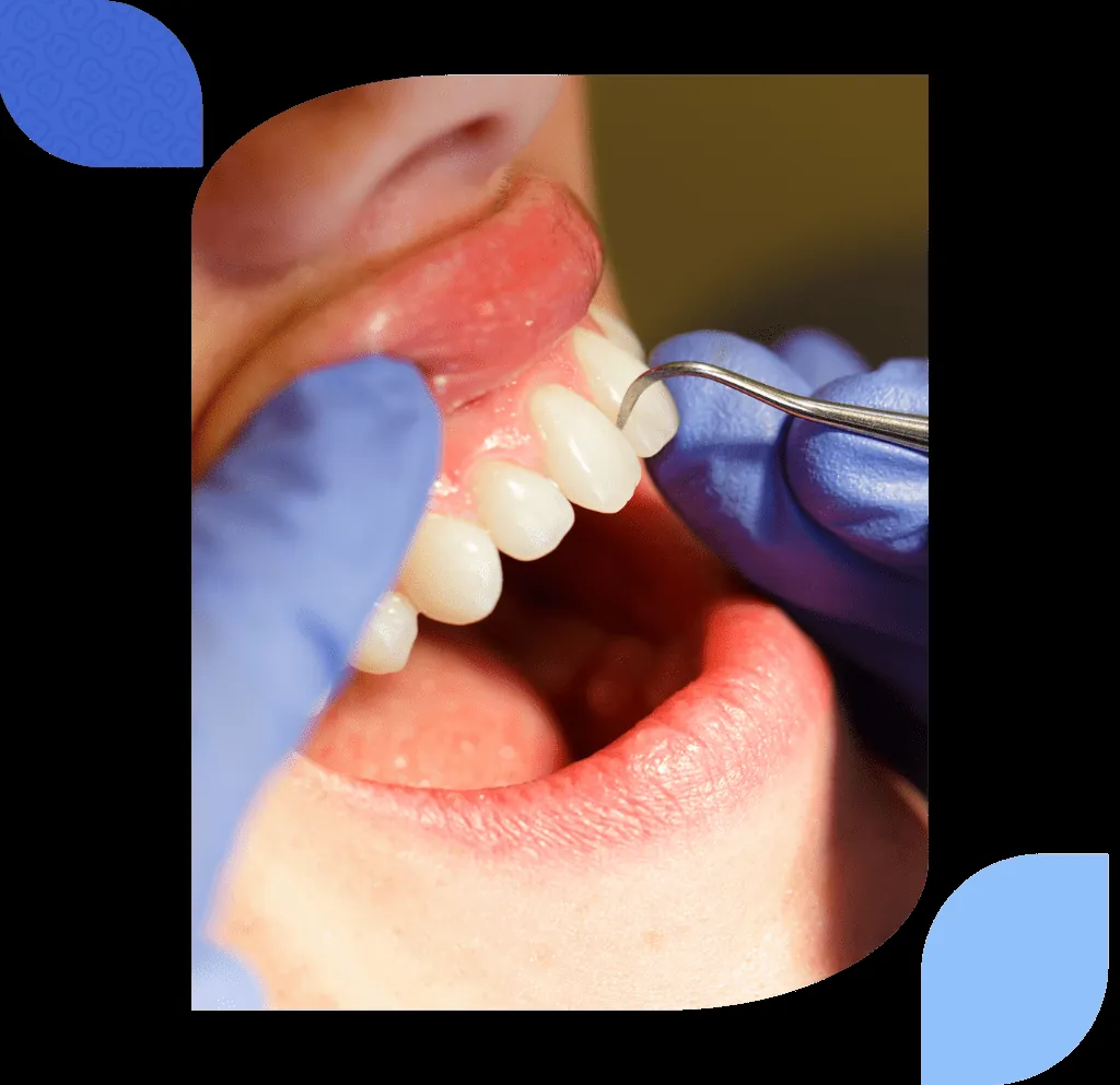 professional dental cleaning bilbao