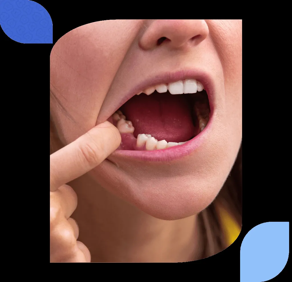 Image accompanying the article: Dental implants in Las Arenas – Getxo