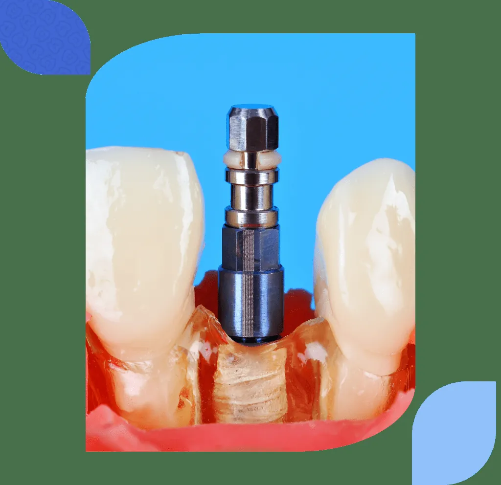 boneless dental implants in bilbao