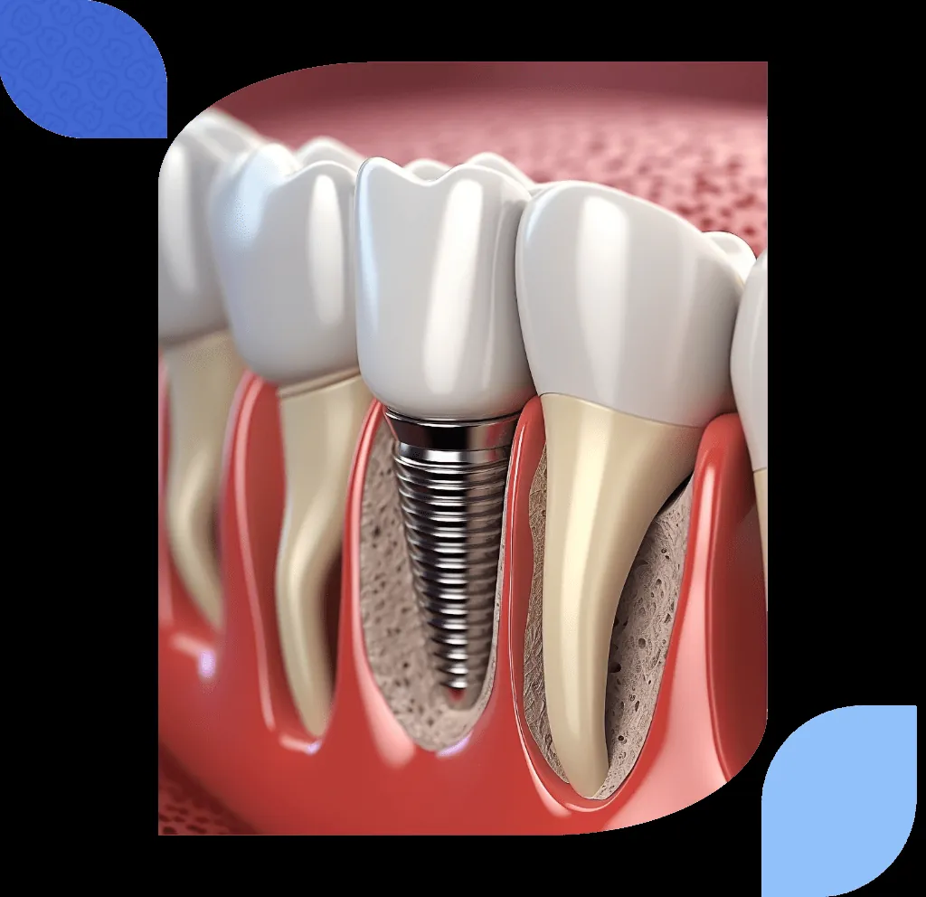 bilbao immediate loading implant (1)