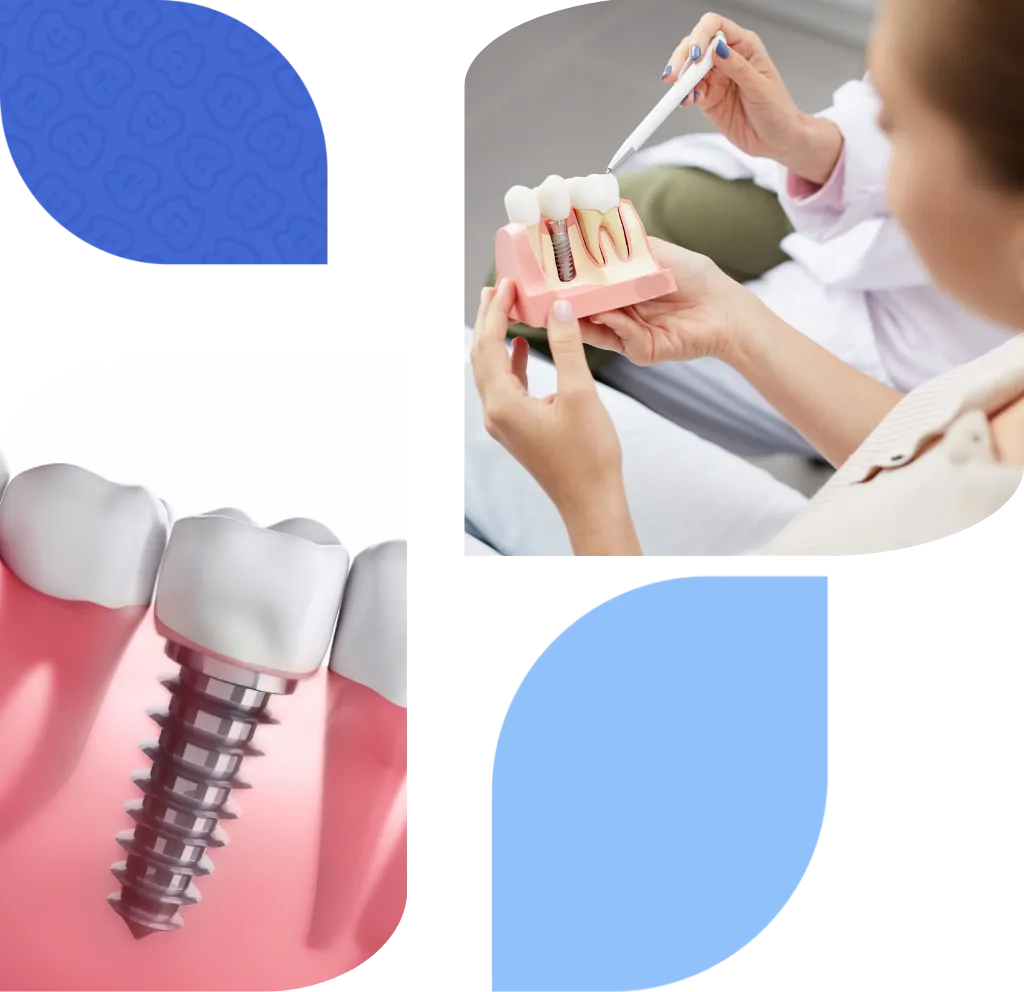 boneless dental implant in bilbao