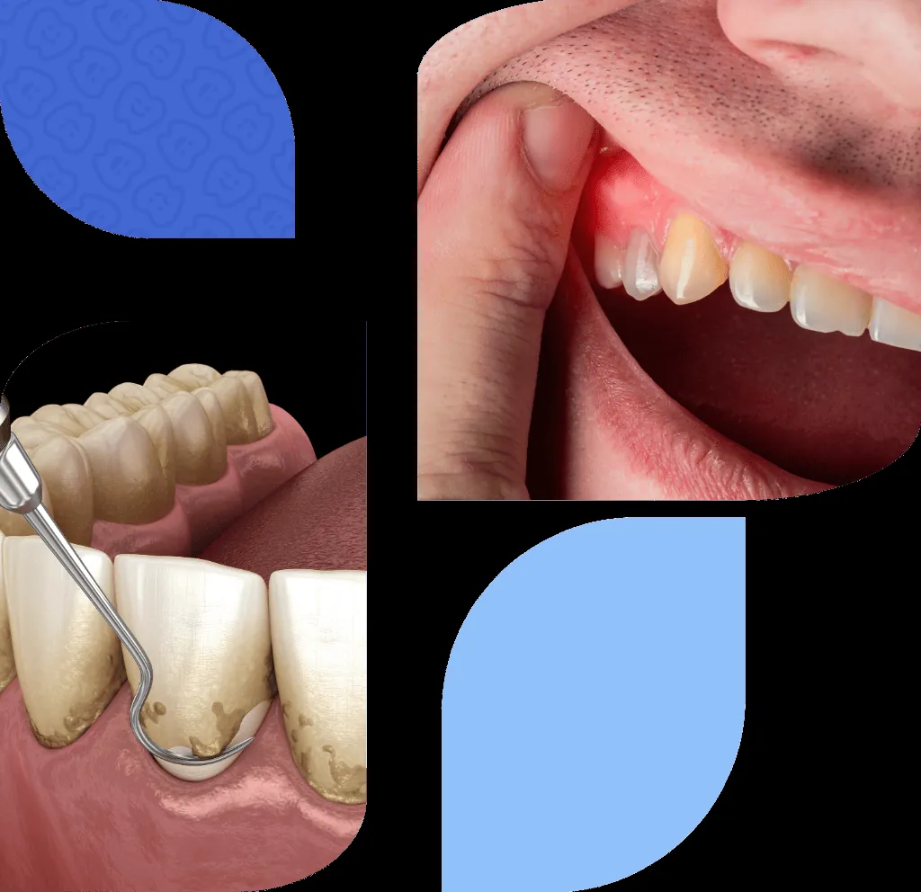 Bilbao periodontics treatment