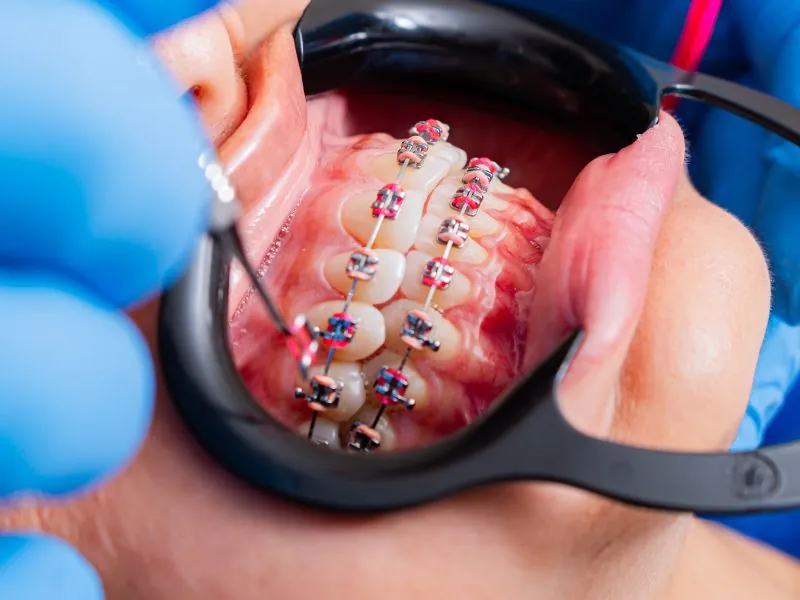 brackets para adultos bilbao