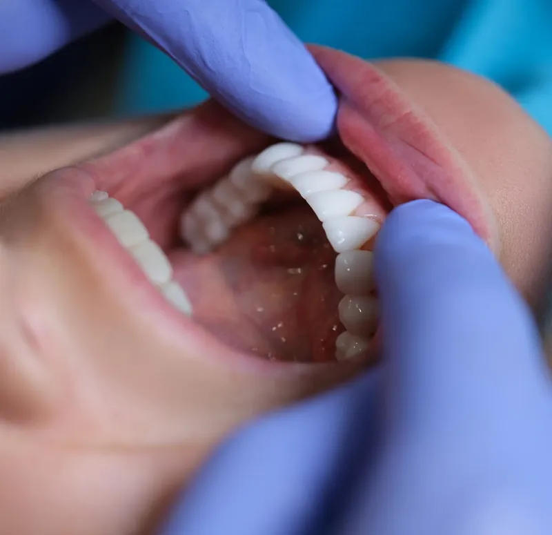 Diabetes and oral health