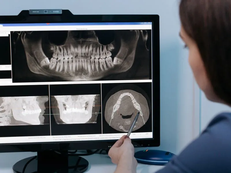 dental implant in getxo