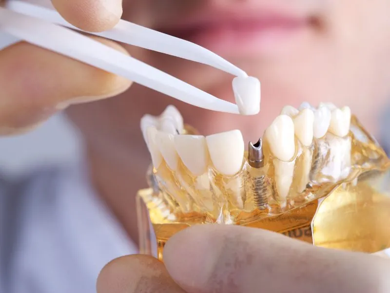 Image accompanying the article: All about dental implants