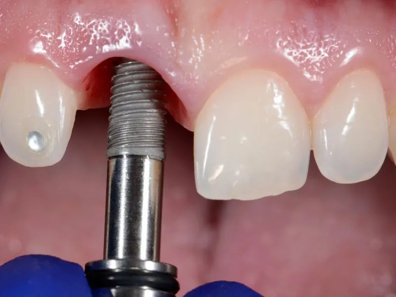 Implante Dental: En qué Consiste y Costo