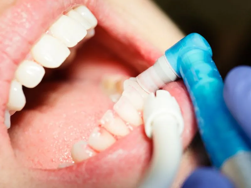limpieza dental en getxo