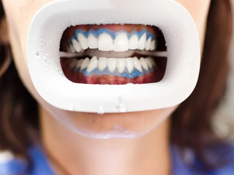 Bilbao tooth whitening