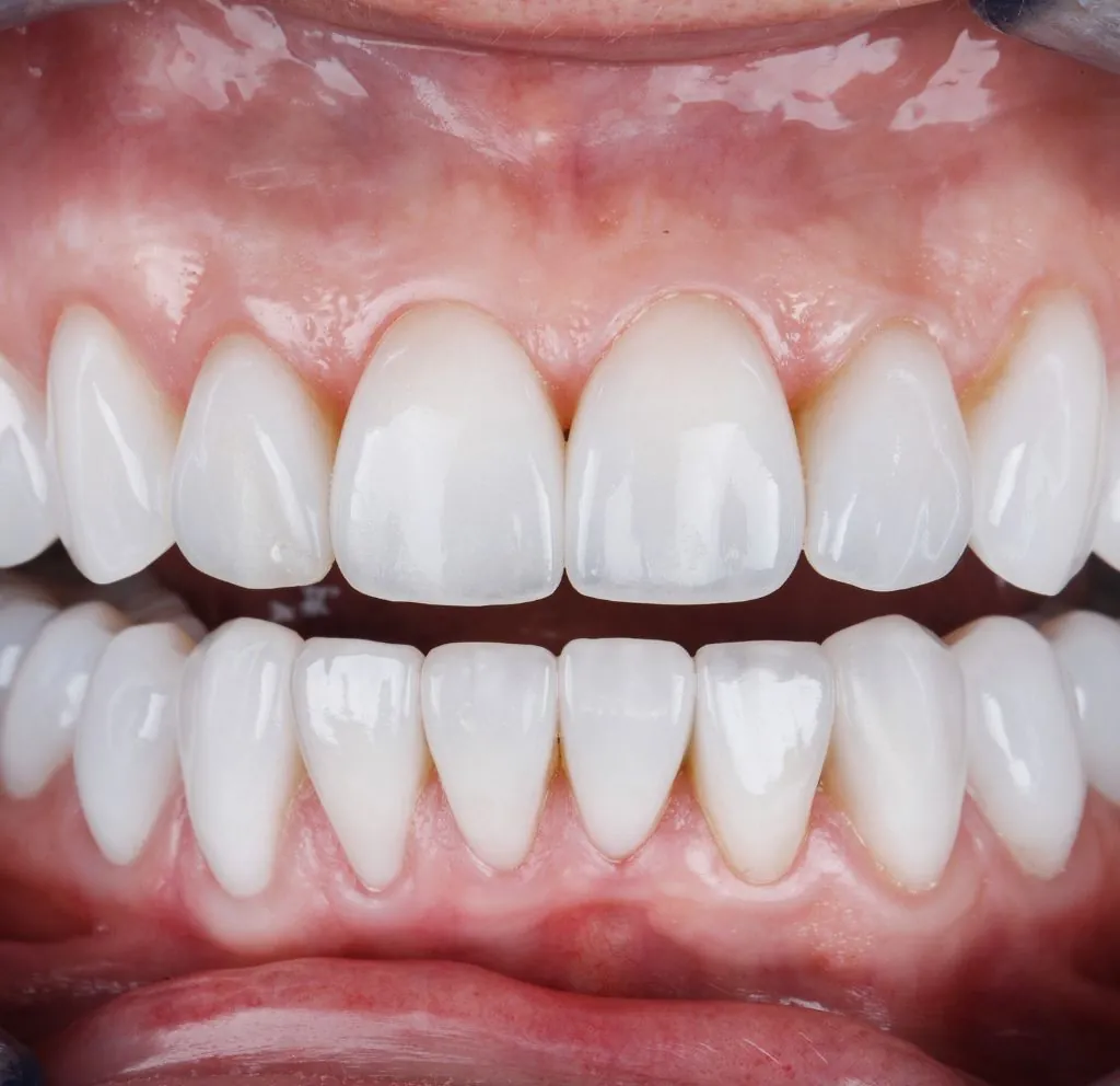 carillas dentales en getxo