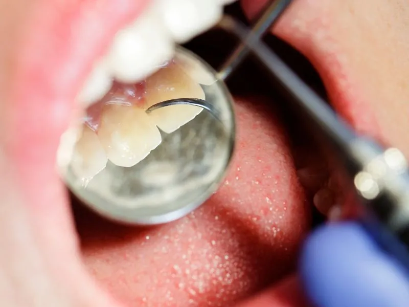 Image accompanying the article: Dental cleaning: What is
