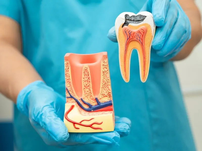 Extracción de raíces dentales