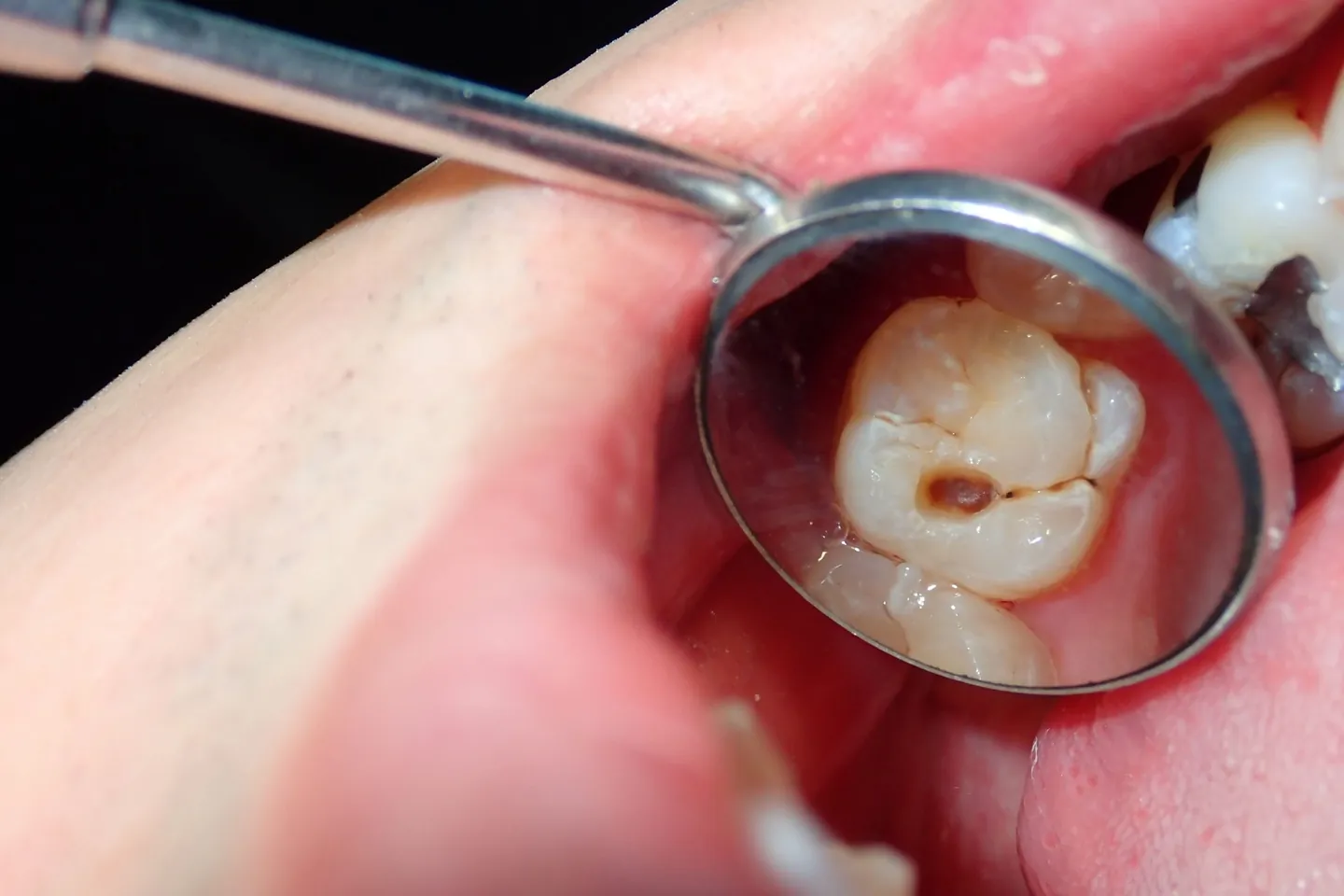 empaste dental en las arenas getxo