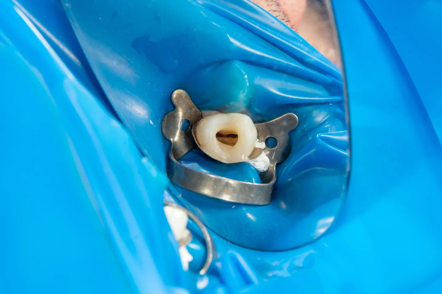 Endodoncia getxo