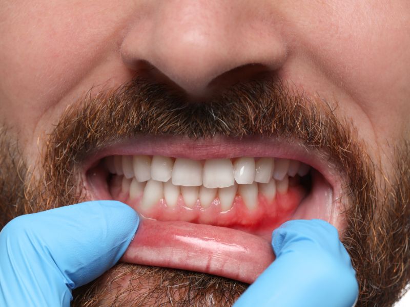 encias inflamadas tratamiento bilbao