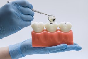 extraccion de muela en bilbao