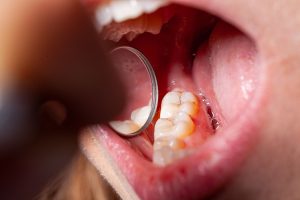 caries tratamiento bilbao (2)
