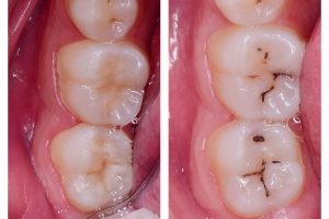 caries tratamiento las arenas getxo